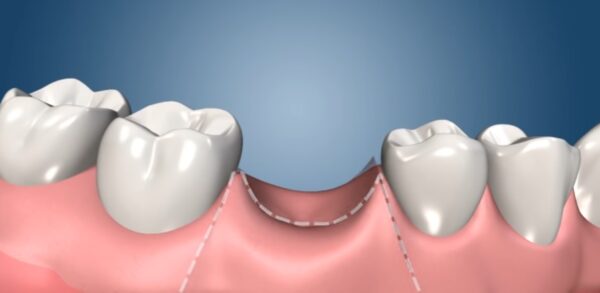 New Look,New Smile, Healty Mouth. All Questions About Dental Implant