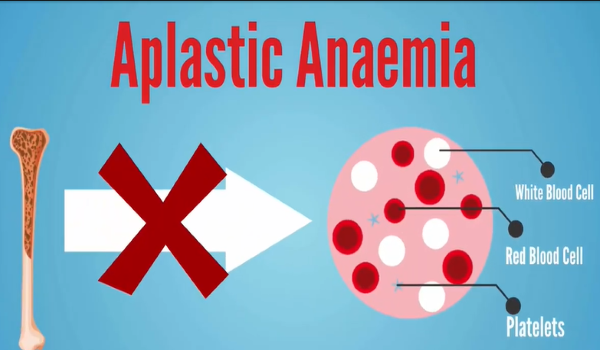 Symptoms of Aplastic Anemia and Causes,Treatment Methods