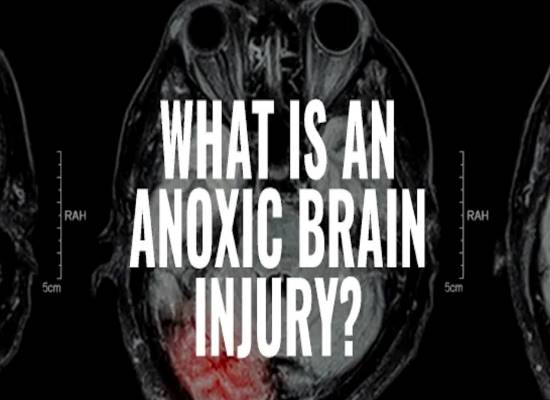 Causes and Treatment Anoxic Brain Injury