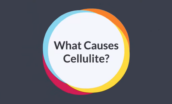 Cellulite causes and latest treatment methods