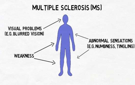 multiple sclerosis (MS) and lemtrada - alemtuzumab