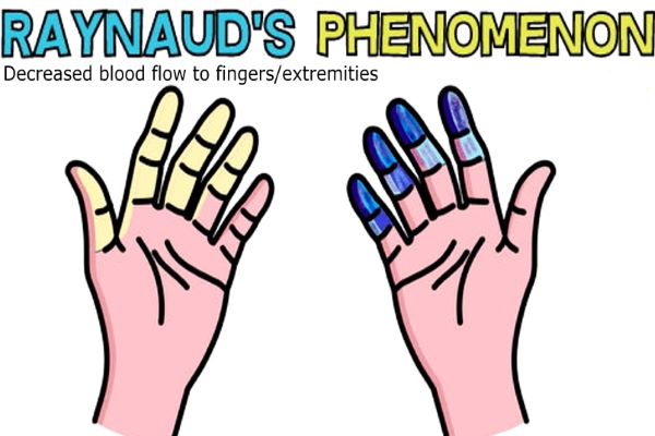 Raynaud's Syndrome Cause Treatment and Avoiding