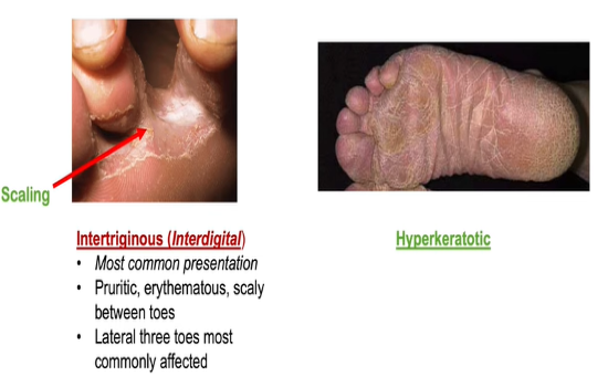 tinea pedis pictures