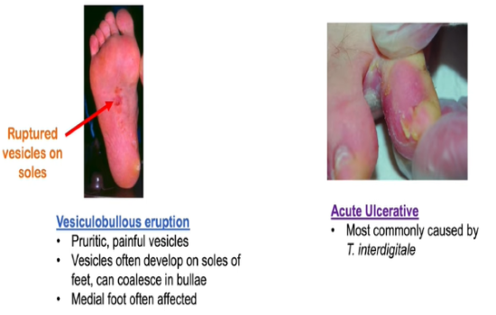 tinea pedis picture 2