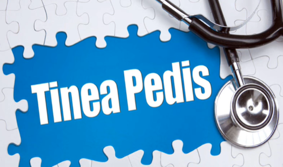 Tinea Pedis And Tinea Capitis & Causes Treatments