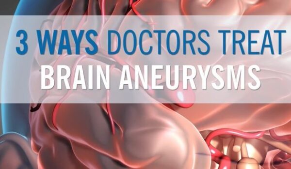 Brain Aneurysm: Causes, Symptoms, Diagnosis, Treatment and Prevention