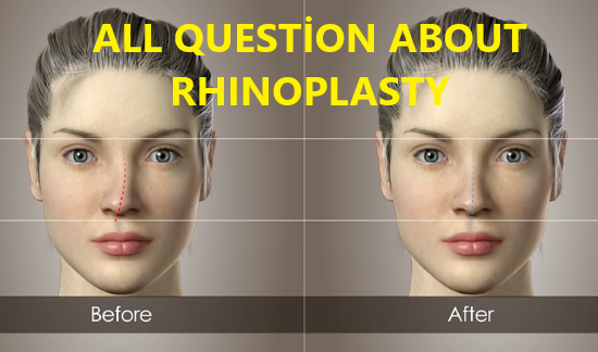 rhinoplasty before abd after