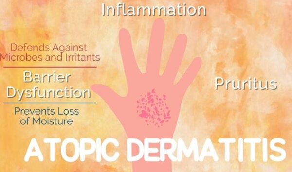 Atopic dermatitis symptoms, causes, diagnosis and treatment. Advice for atopic dermatitis.