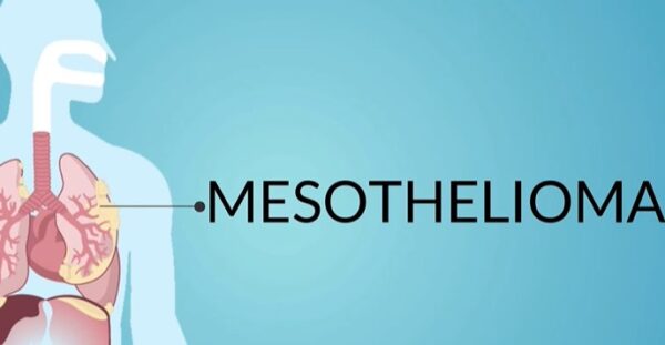 mesothelioma